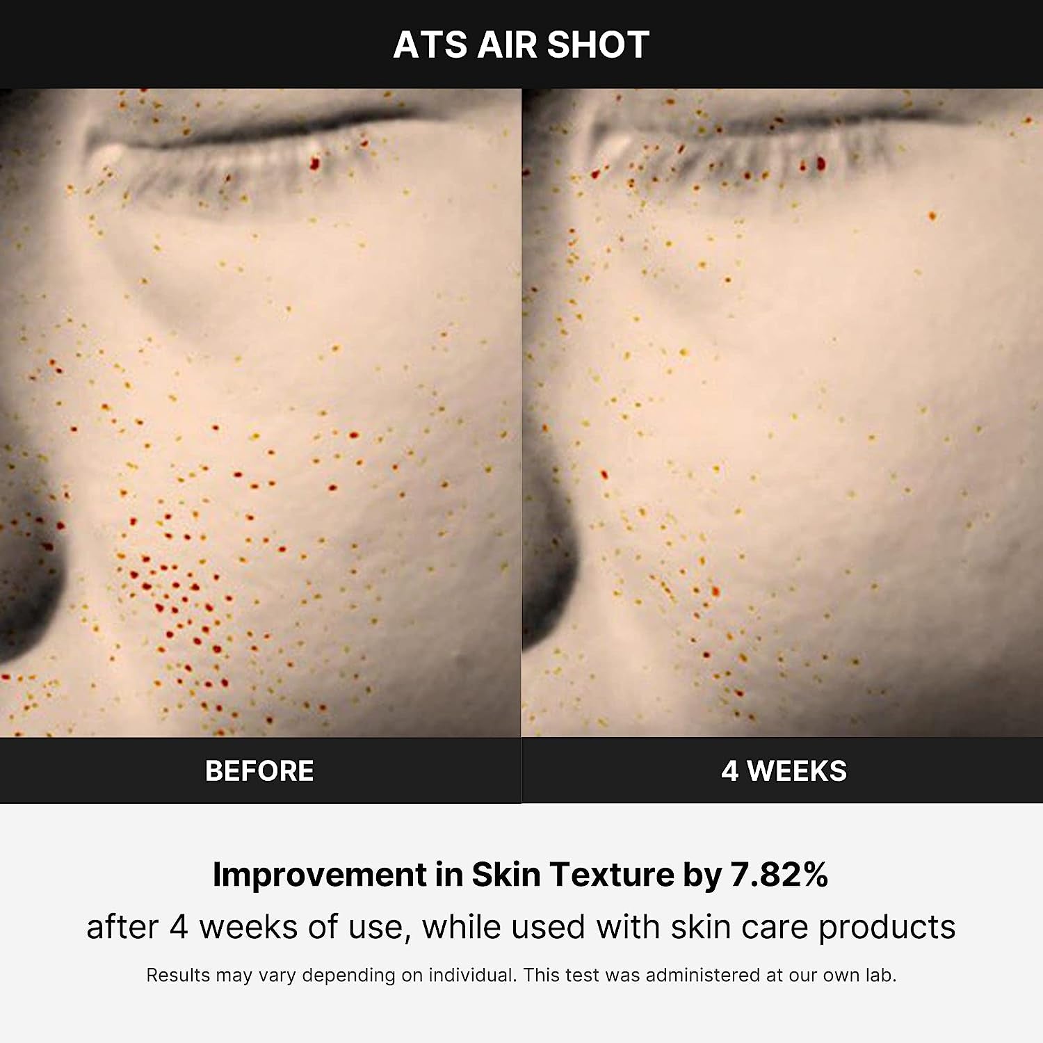 Transform Your Skin with the Age-R ATS Air Shot - The Ultimate Microneedling Pore Tightening Device for Exquisite Absorption, Refined Pores, and Silky Smooth Texture!